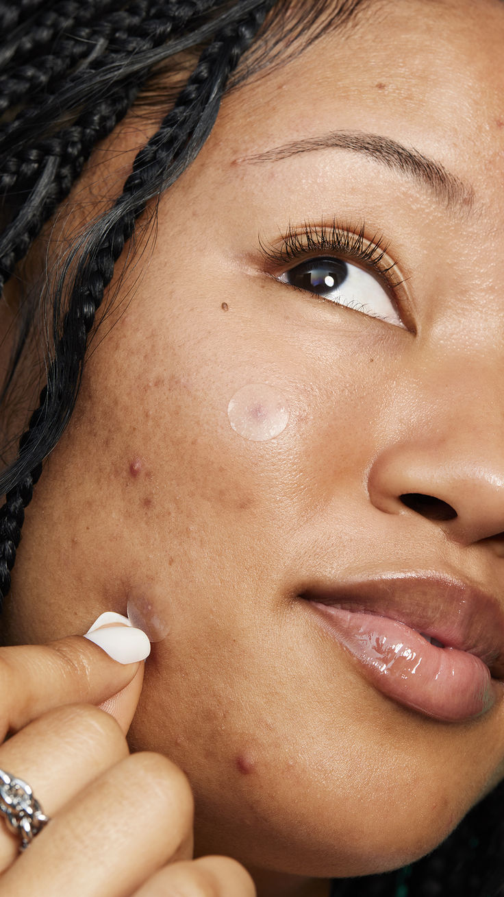 FreshFace Luxe Hydrocolloid Pimple Patches – 360pcs