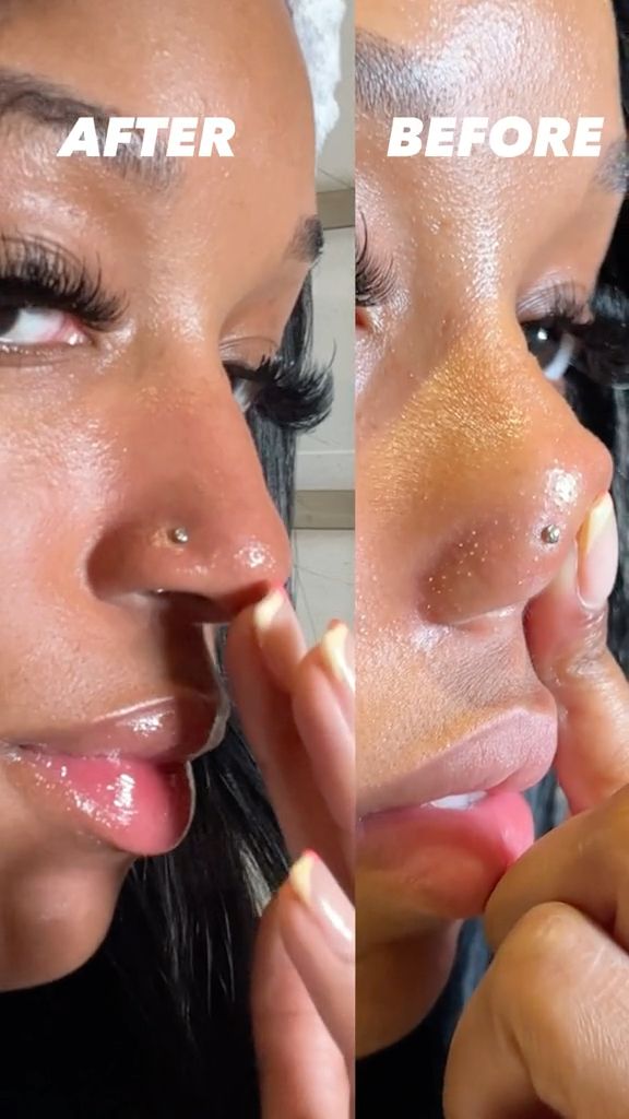 GlowPure™ Blackhead Remover